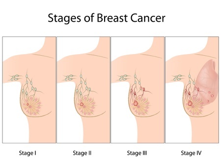 The 4 stages of Breast Cancer
